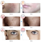 Photon Therapy Beauty Mask